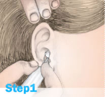 助听器取耳样的步骤